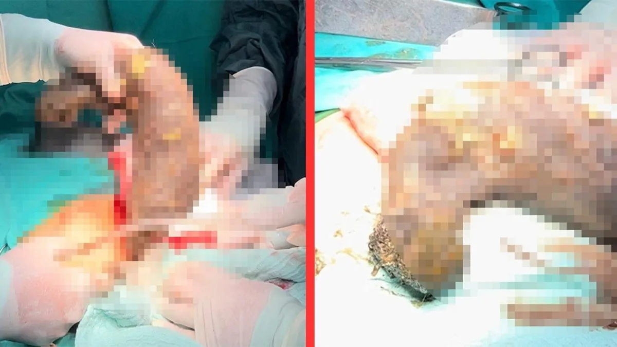 Doktorlar bile şaşkın: Midesinden 50 santim saç yumağı çıktı!